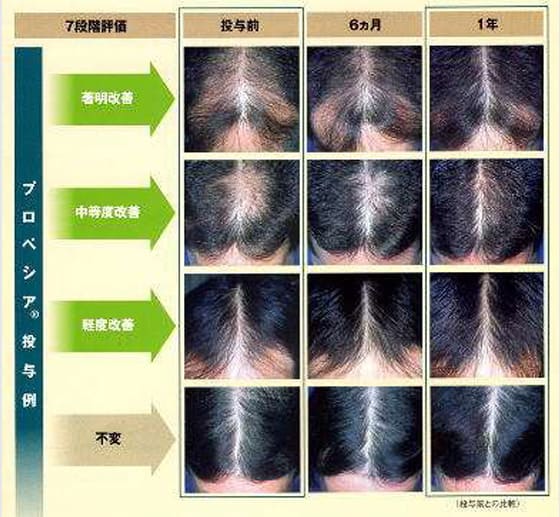 プロペシア投与例